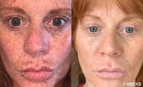 Before and after comparison of a woman's face with visible freckles, showing a 2-weeks difference.